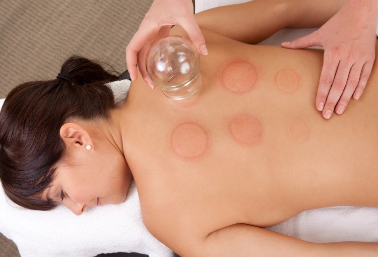 Cupping Therapy Teatment Stirling